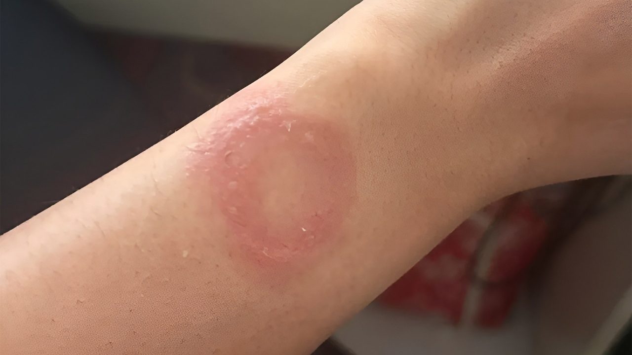 Pengguna Apple Watch alami Luka bakar
